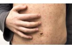 Measles protection is paramount before traveling outside the US, says&nbsp;CDC