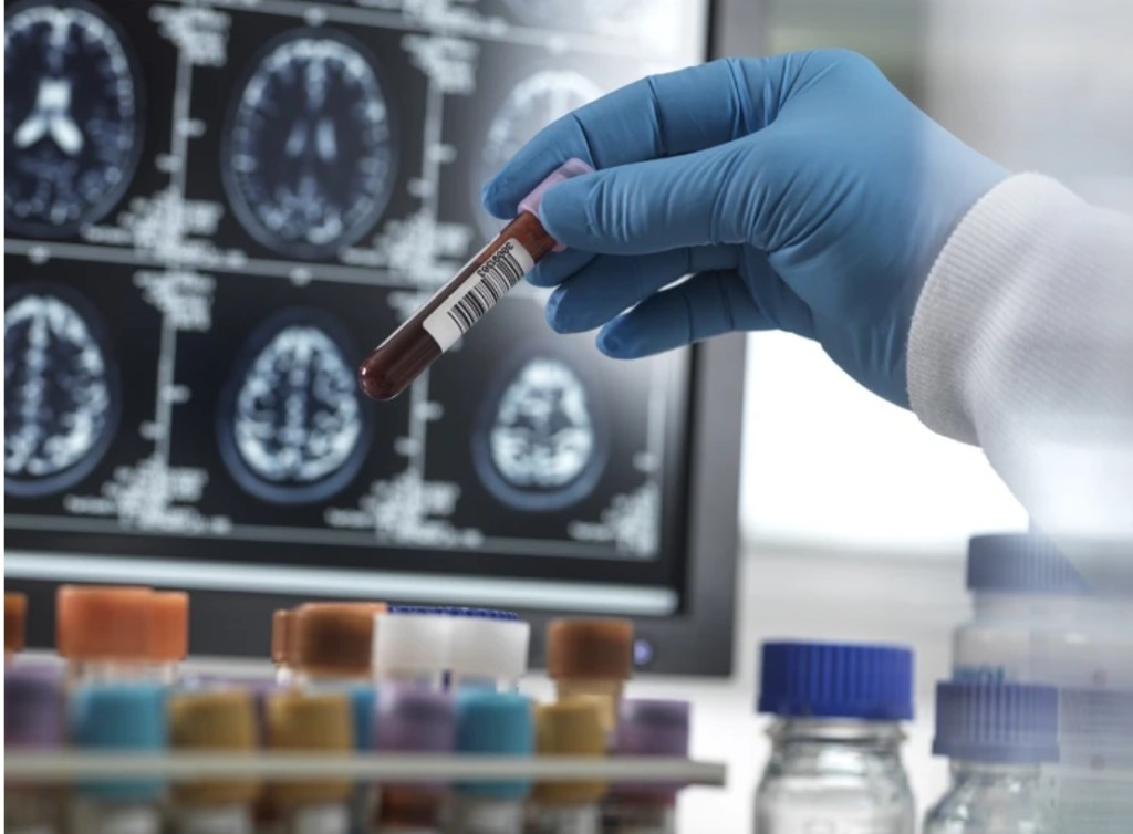 How common is Alzheimer’s? Blood-test study holds&nbsp;surprises